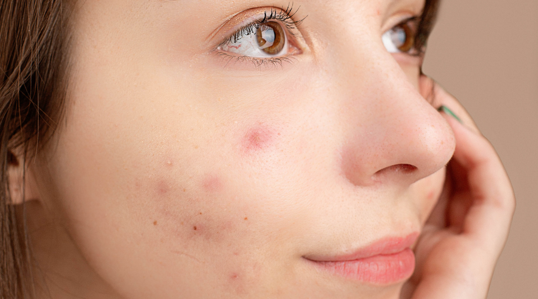 Wat zijn de beste natuurlijke ingrediënten tegen acne? (zonder je huid uit balans te brengen)